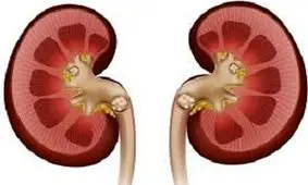 سنگ کلیه چیست و چه کسانی به آن مبتلا می شوند؟
