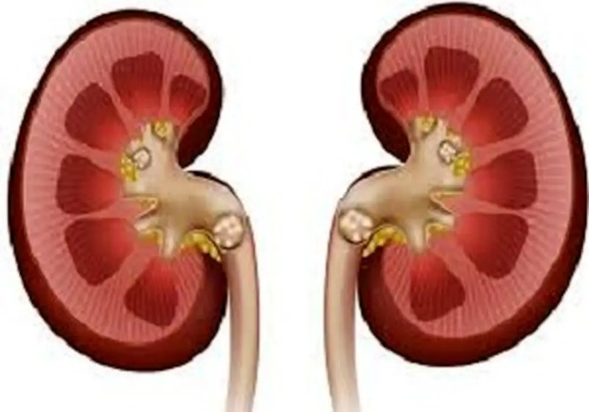 سنگ کلیه چیست و چه کسانی به آن مبتلا می شوند؟