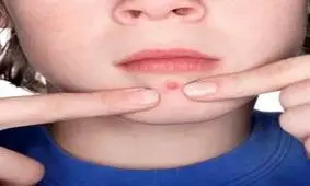 ترکاندن جوش کدام ناحیه از صورت خطرناک است؟