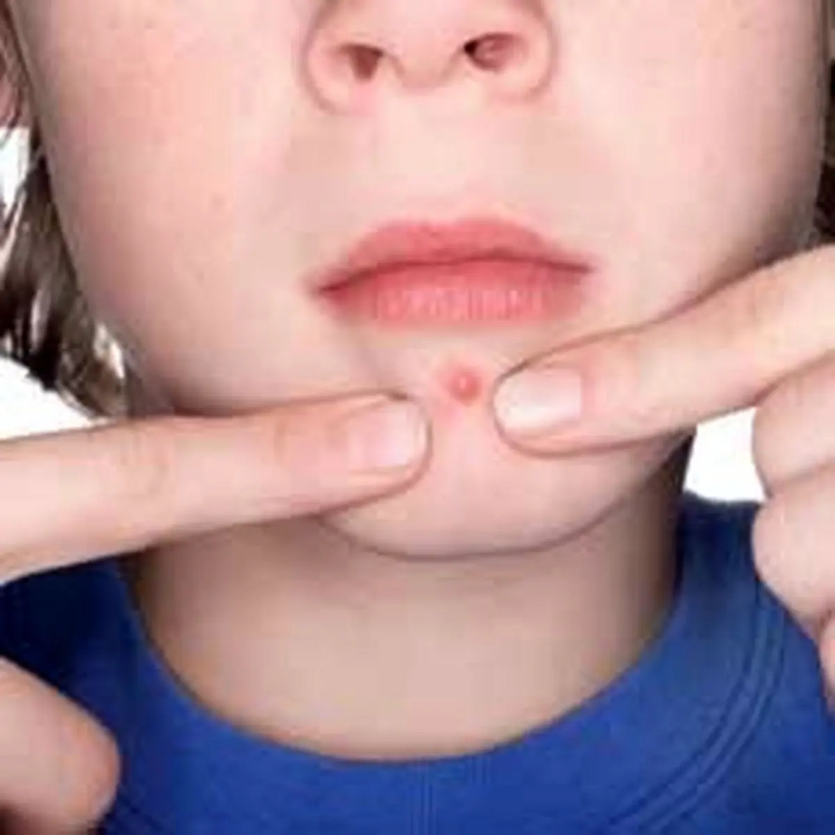 ترکاندن جوش کدام ناحیه از صورت خطرناک است؟