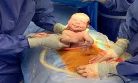 سزارین زودهنگام نوعی کودک آزاری و مرگ‌آور است