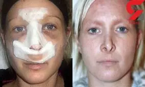 بلای وحشتناکی که پس از جراحی زیبایی بینی سر زن ۴۱ ساله آمد +عکس