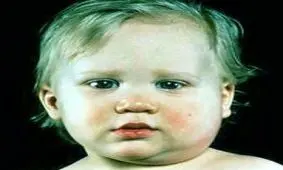 با خطرناکترین بیماری فصل بهار چکار کنیم؟