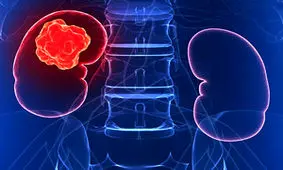 نشانه‌های یکی از خطرناک‌ترین سرطان‌ها را بشناسید