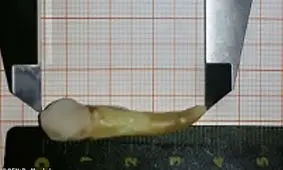 رکورد بلندترین دندان انسان در جهان شکسته شد