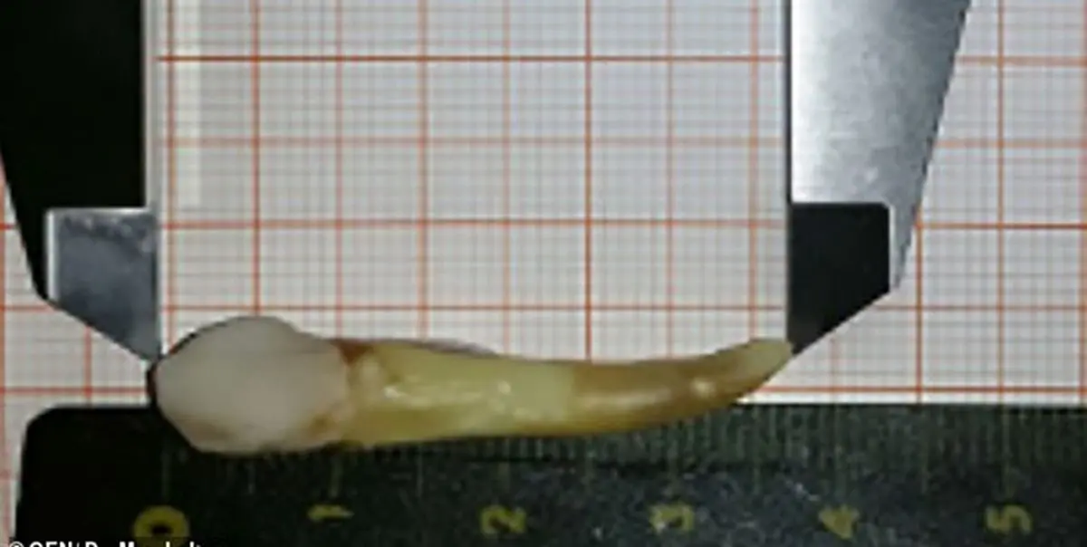 رکورد بلندترین دندان انسان در جهان شکسته شد