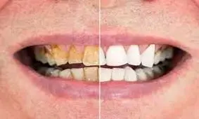 فرمول‌های ساده برای جلوگیری از پوسیدگی دندان + غذاهای مضر برای سلامت دندان