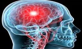 دلایل سکته مغزی در زنان، راه پیشگیری