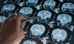 امید به درمان آلزایمر با داروی جدید