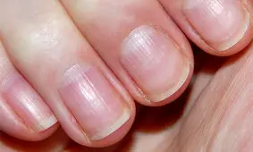 علت خطوط روی ناخن و راه‌های درمان آن
