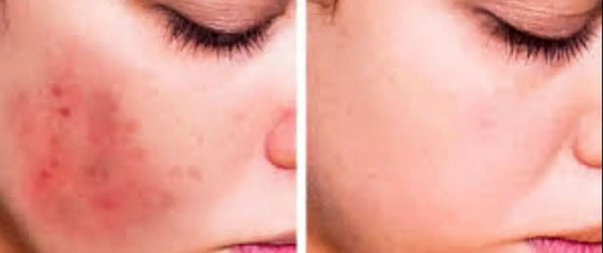 با این ۵ روش از شر لکه‌های پوستی خلاص شوید