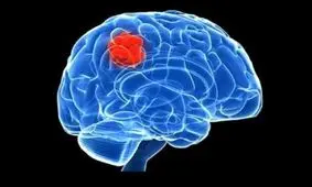 نشانه‌های تومورهای مغزی/ سردردهای خطرناک را بشناسید!