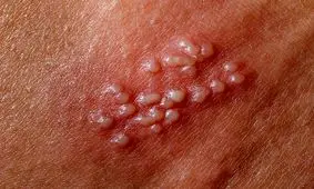 زندگی همیشگی با ویروس تبخال تناسلی