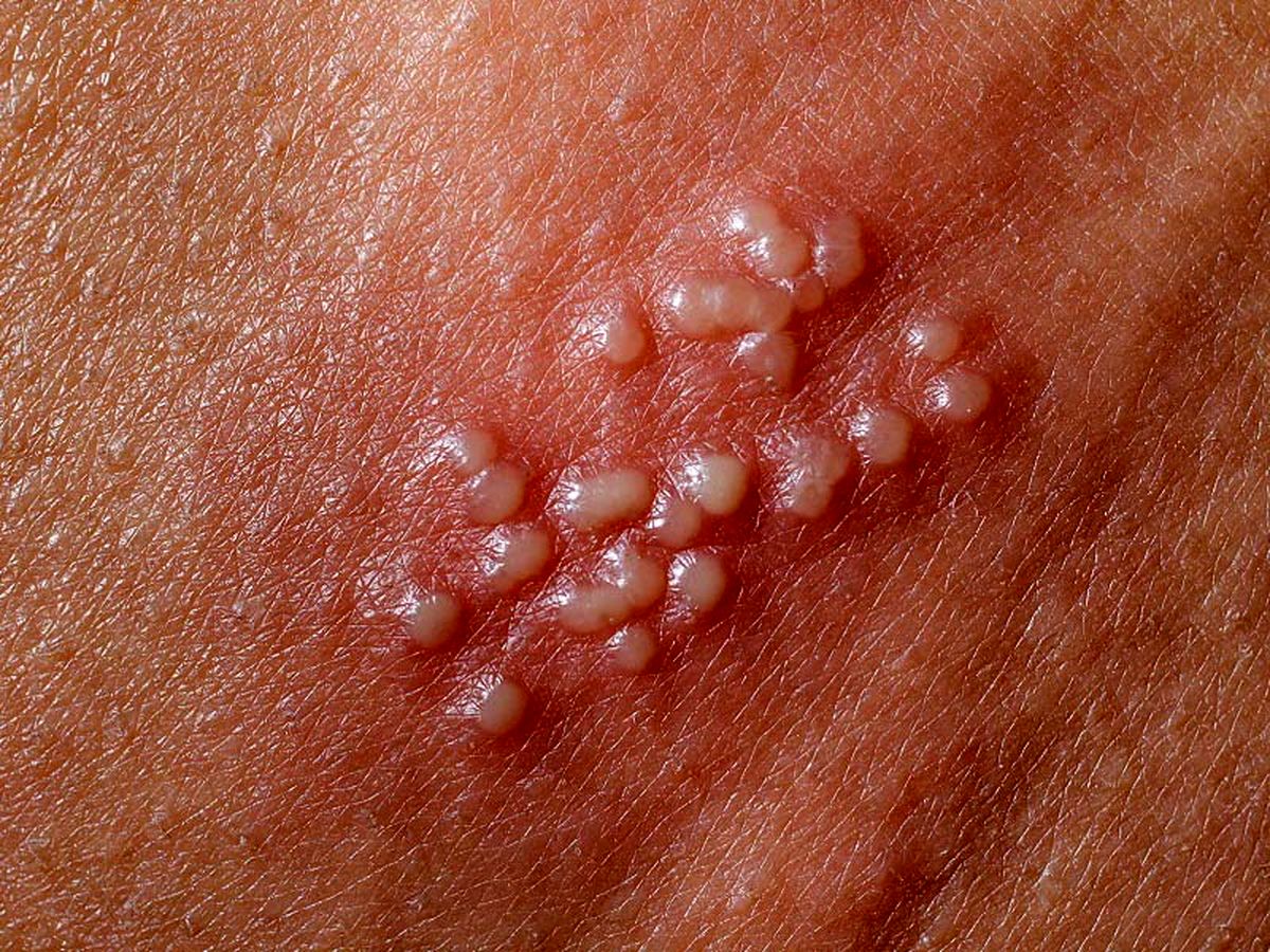 زندگی همیشگی با ویروس تبخال تناسلی
