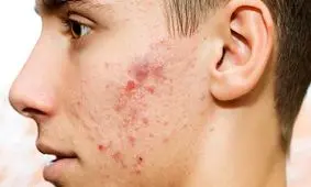 جوش‌های سرسیاه را با موثرترین راهکار‌ها محو کنید