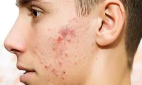 جوش‌های سرسیاه را با موثرترین راهکار‌ها محو کنید