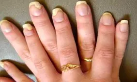 عفونت قارچی ناخن در یک قدمی شماست