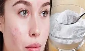 جوش شیرین برای جوش صورت