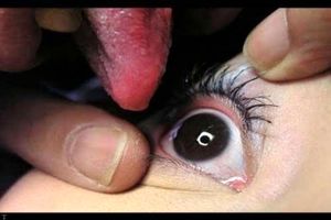 درمان عجیب چشم توسط پیرزن بوسنیایی