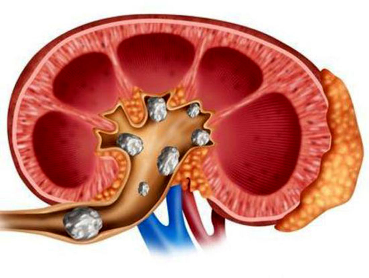 سنگ کلیه را با این فرمولهای خانگی نابود کنید
