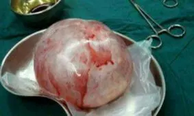 توده چهار کیلویی در شکم بیمار سبزواری