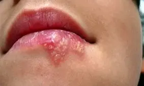 چگونه از بروز تبخال پیشگیری کنیم؟