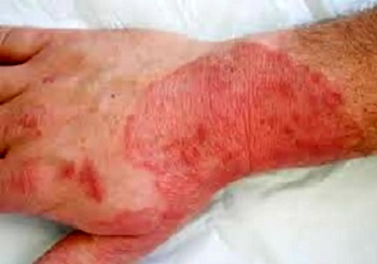 درمان قطعی برای انواع سوختگی ها