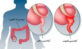 تفاوت درد آپاندیس با سایر دردها چیست؟