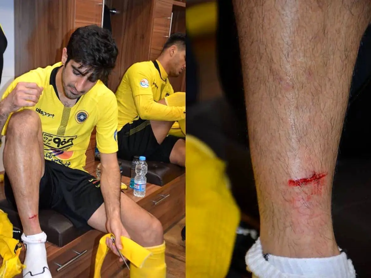 حسینی: خدا رحم کرد پایم نشکست