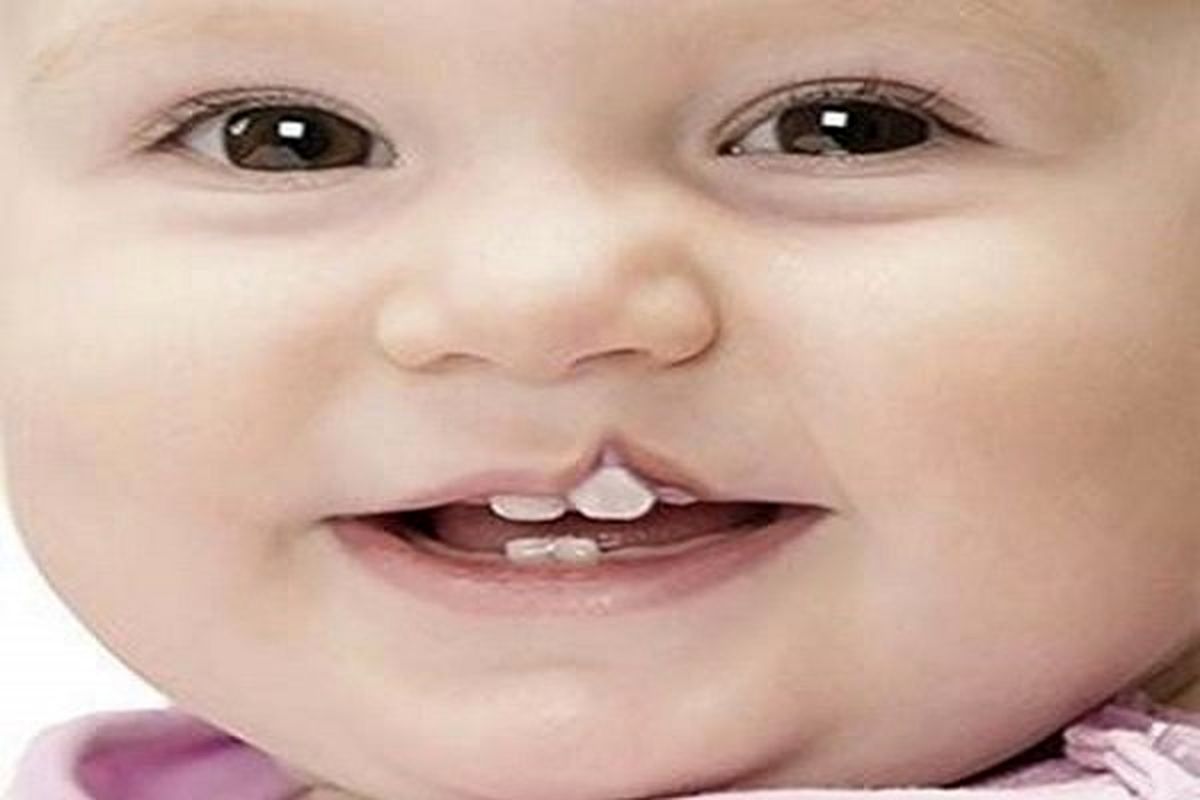 «مرهم» بر لبهای کودکان
