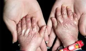 "آوا"، قربانی تحریم‌ها/ آخرین وضعیت درمان پروانه‌ای‌ها