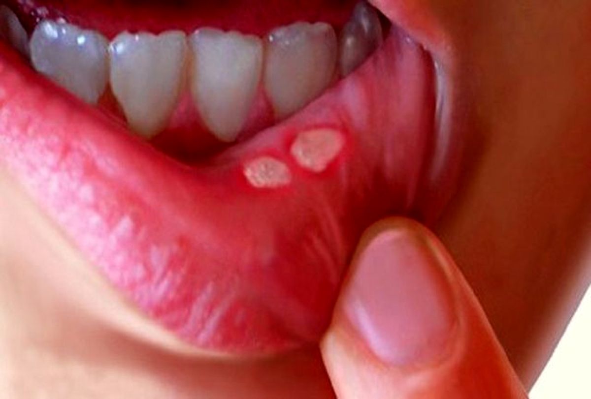 زخم‌های داخل دهان را جدی بگیرید