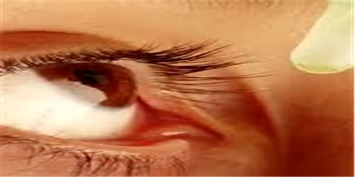 چه کسانی گرفتار تیروئید چشم می شوند؟ + علائم و درمان