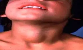 4 راه طبیعی برای درمان و کنترل پرکاری تیروئید