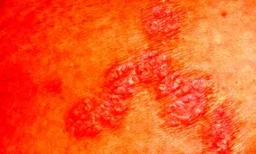 آلودگی هوا و پیامدهای خطرناکش برای پوست