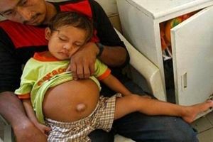 در پرو یک کودک سه ساله به طرز عجیبی حامله شد