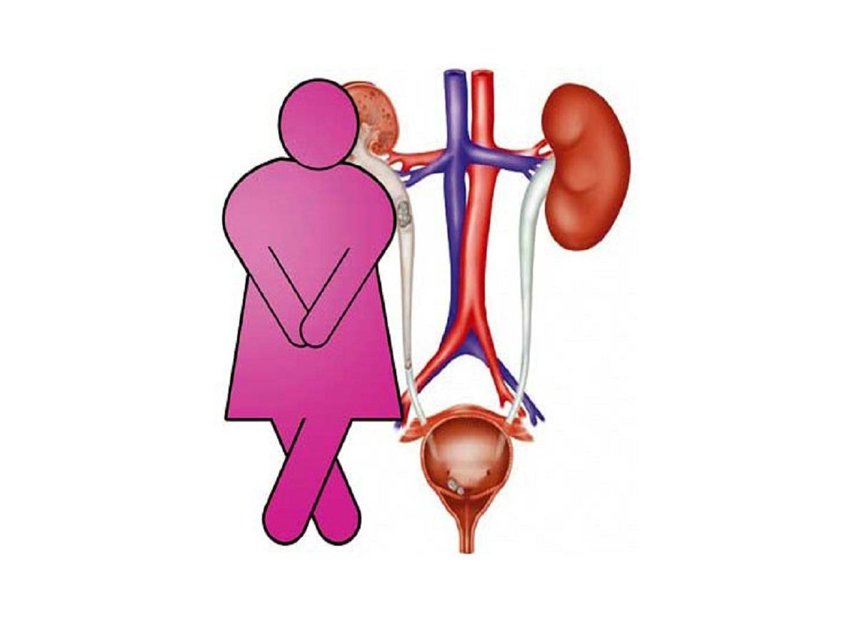 علل بروز بیاختیاری ادراری در زنان چیست؟