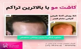 کاشت مو و ابرو توسط دکتر رضا روحانی در کلینیک رز