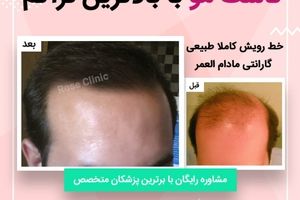کاشت مو و ابرو توسط دکتر رضا روحانی در کلینیک رز