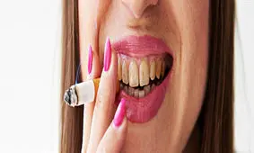 دردسرهای سیگار برای دهان و دندان!