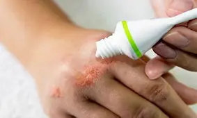 بهترین راهکارها برای تسکین علائم اگزما