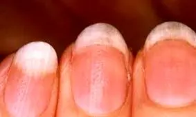 ۸ شکل و ظاهر غیر متعارف ناخن ها معرف ۸ مشکل بزرگ در سلامتی