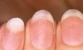 ۸ شکل و ظاهر غیر متعارف ناخن ها معرف ۸ مشکل بزرگ در سلامتی