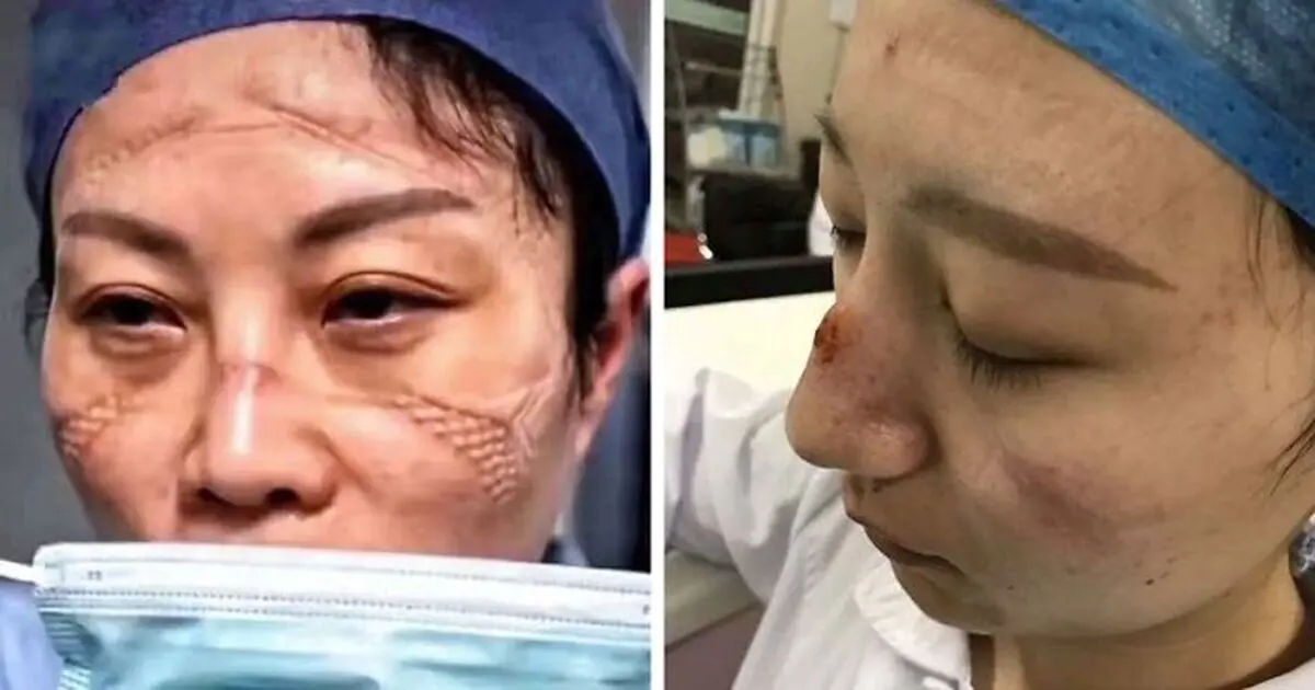 تصاویری دردناک از چهره پرستاران در ووهان چین