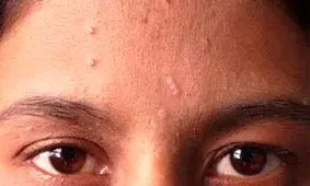 هر آنچه درباره زگیل‌ها باید بدانید