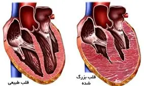 اینفوگرافی| شایع‌ترین دلایل و علائم نارسایی قلبی