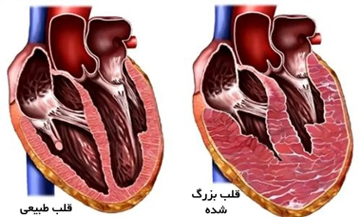 اینفوگرافی| شایع‌ترین دلایل و علائم نارسایی قلبی