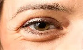 چرا صبح بعد بیدار شدن از خواب چشم‌ها پف دارند؟