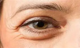 چرا صبح بعد بیدار شدن از خواب چشم‌ها پف دارند؟
