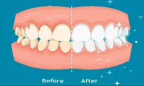 با بلیچینگ، دندان‌هایی زیباتر داشته باشید